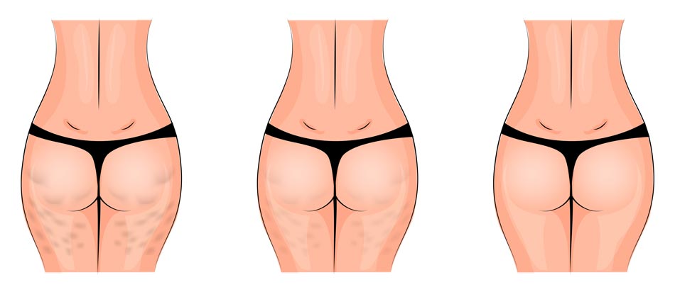 Natural anti-cellulite treatments